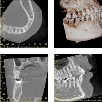 3次元の歯科用CT画像