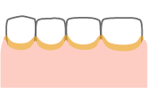 歯と歯肉の境目