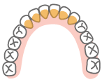 下顎前歯の舌側