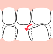 周辺の歯の移動-2