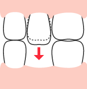 周辺の歯の移動-3