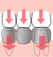 圧力がかかるので歯の寿命は短くなります