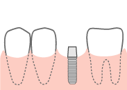 インプラントを埋める