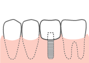 インプラントに被せ物をする