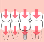 周囲の歯のダメージは少ない