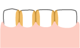 歯と歯の間