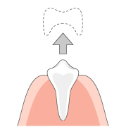 永久歯の出来方