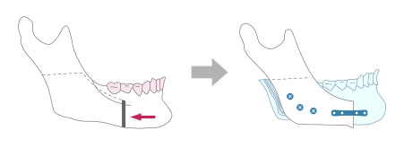 下顎のみ手術を行う場合