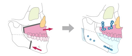 上下顎の両方手術を行う場合