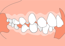上顎前突（出っ歯）