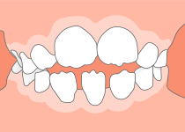 開咬（前歯が咬んでいない）