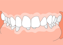 過蓋咬合（前歯の咬み合わせが深い）