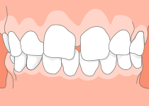 空隙歯列